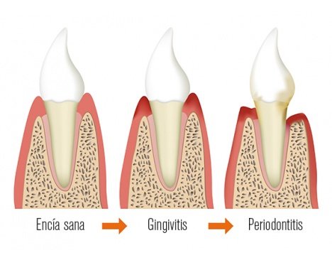 La malaltia periodontal