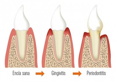 La malaltia periodontal