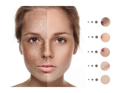 PEELING QUÍMIC PER A L'ELIMINACIÓ DE TAQUES