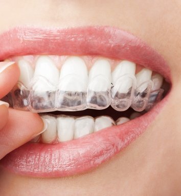 Ortodòncia i Invisalign