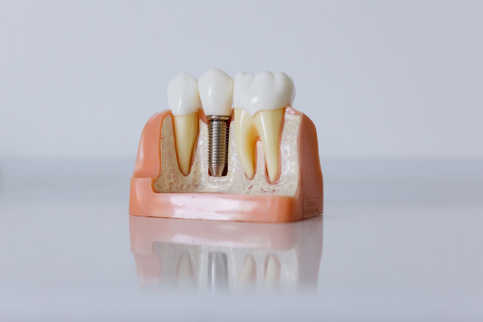 Fotografía ilustrativa de un modelo dental con un implante